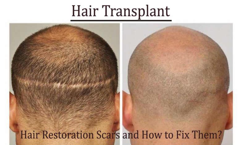 hair transplant- Hair Restoration Scars and How to Fix Them?