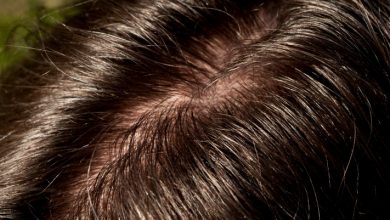 Scalp Acne and Oily Hair Issues