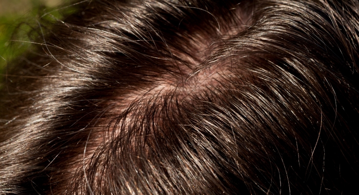 Scalp Acne and Oily Hair Issues