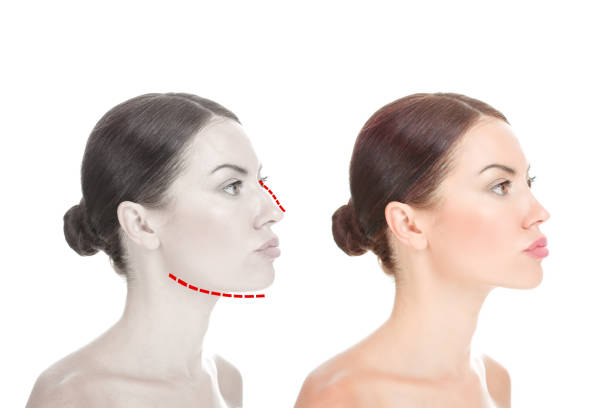 Kybella Treatment