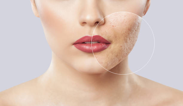 Scar Removal Treatment