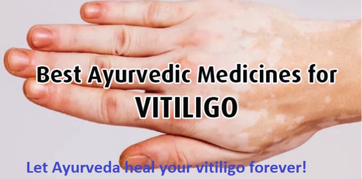 Ayurveda heal your vitiligo forever