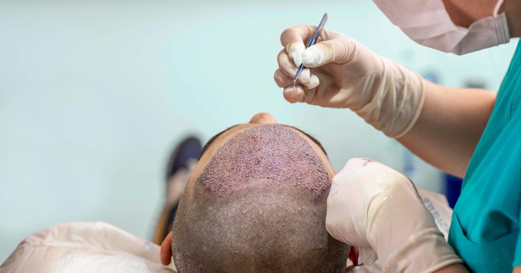 Hair transplant