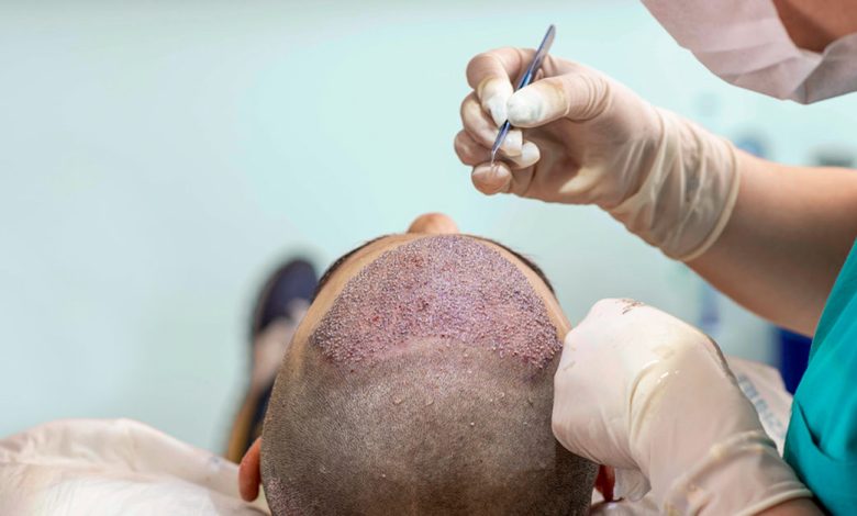 Hair transplant