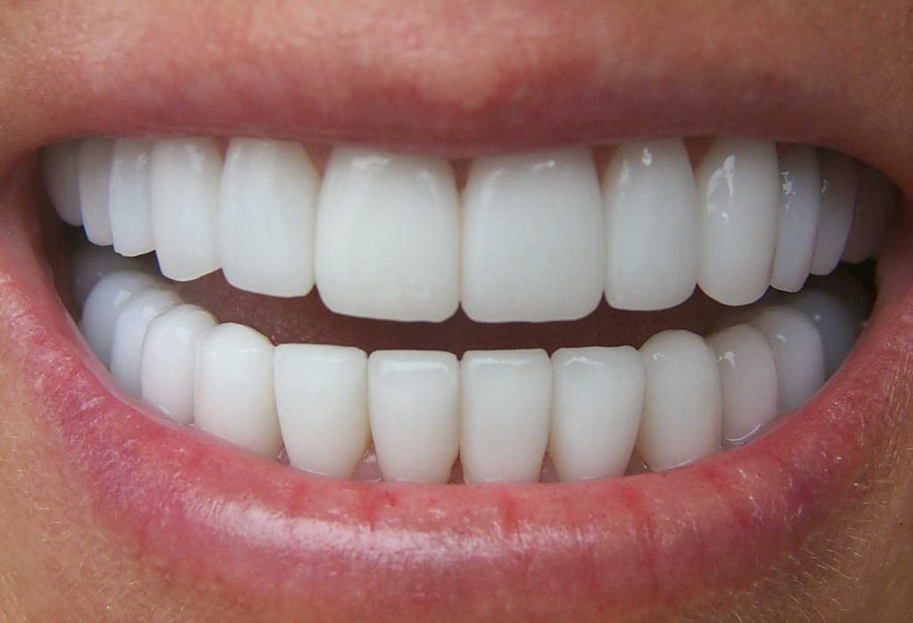 temporary veneers