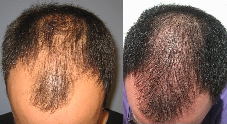 HAIR LOSS TREATMENT AND DIAGNOSIS